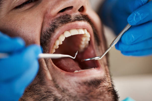 Best Emergency Treatment for Dental Infections or Abscesses in Livingston, CA
